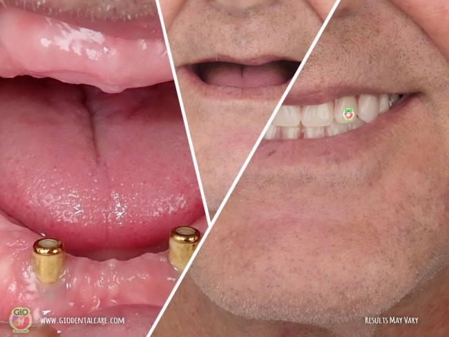gio-dental-implants-1
